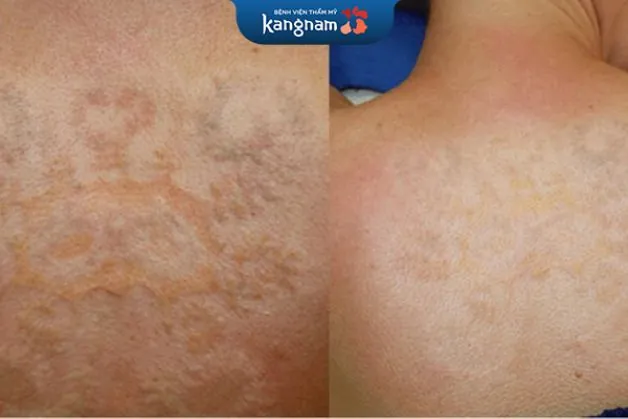 Tẩy xăm dân gian dễ bị sẹo và khiến da kém mịn màng