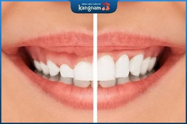 Cắt lợi chỉ là một tiểu phẫu rất nhỏ và đơn giản