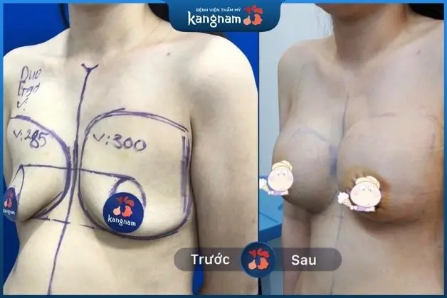 Khắc phục ngực chảy xệ kém duyên chỉ sau một ca phẫu thuật