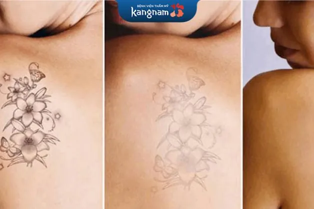 Xóa hình xăm 1 lần có hết không?