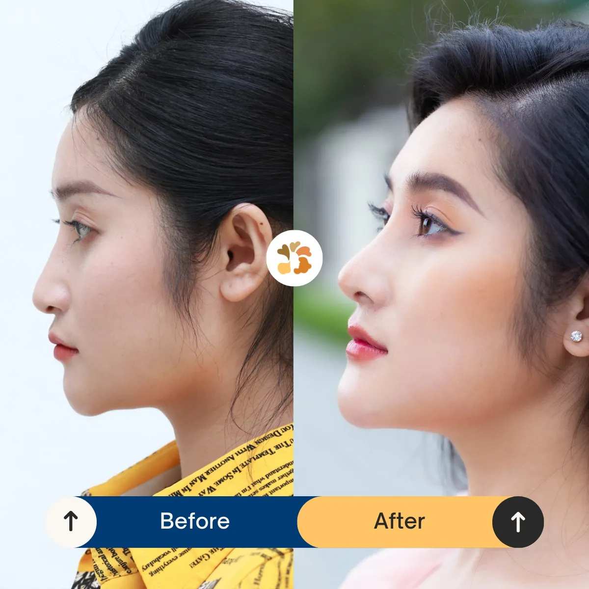 Tìm hiểu phương pháp sửa mũi từ đó biết chi phí sửa mũi ngắn hếch bao nhiêu tiền
