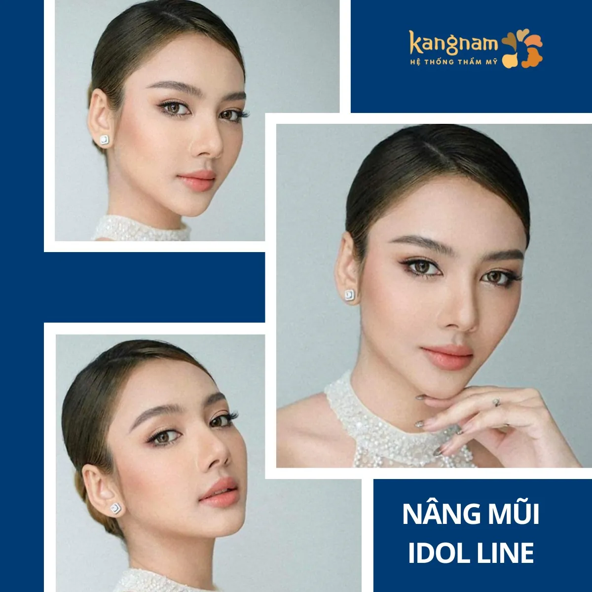 Khuôn mặt chuẩn tỷ lệ vàng khách hàng nâng mũi Kangnam 