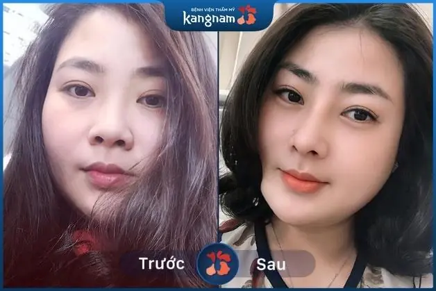 Hình ảnh khách hàng sau khi nâng mũi tại Kangnam