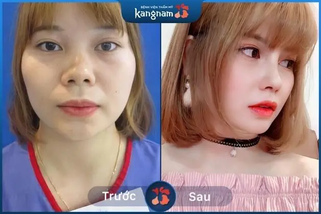 Khách hàng sau khi nâng mũi được 3 tháng