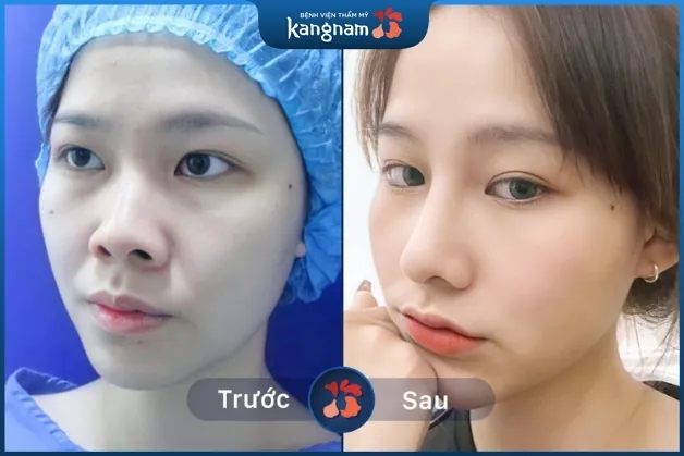 Cắt cánh mũi hiệu quả vĩnh viễn sau 1 lần thực hiện tại Kangnam