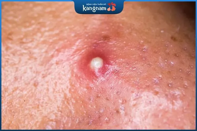 Điều trị mụn đinh râu bằng thuốc bôi