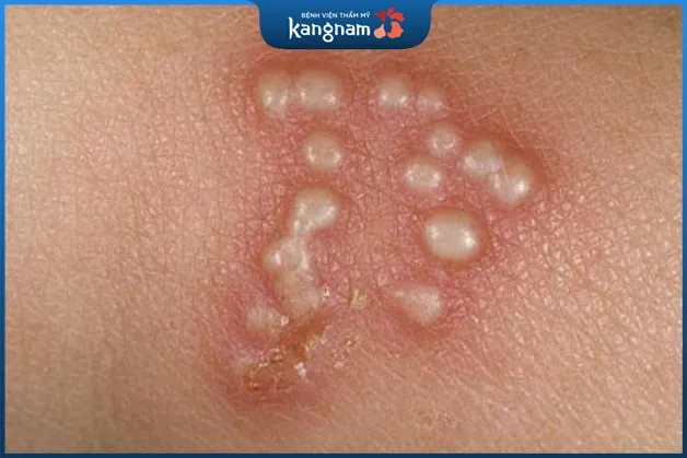 Điều trị mụn sinh dục nữ bằng laser