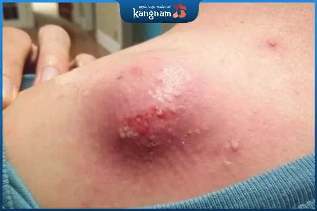 Mụn bã đậu có gây nguy hiểm không?