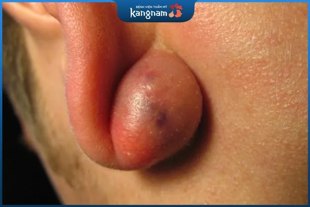 Mụn bã đậu còn có nhiều tên gọi khác là u nang tuyến bã hay u nang bã đậu