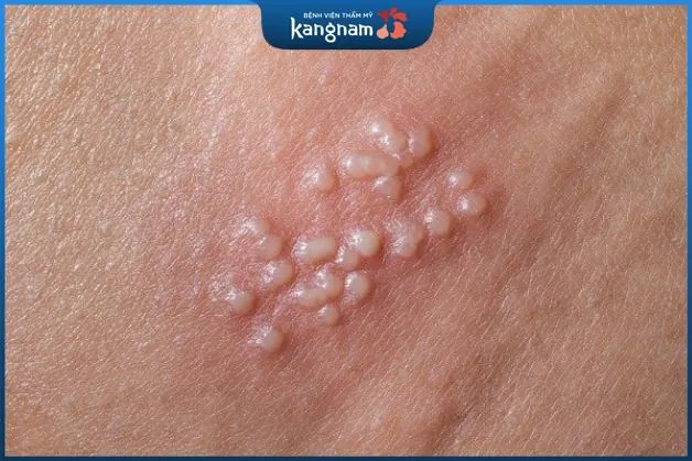 Mụn rộp sinh dục là gì?