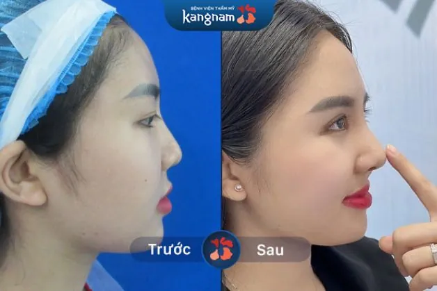 Mũi cao thanh thoát, tự nhiên