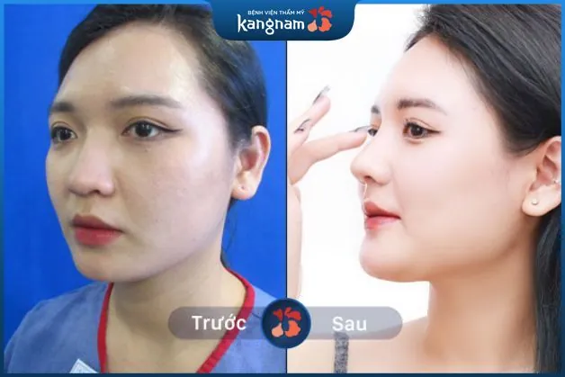 Khắc phục cánh mũi to thô