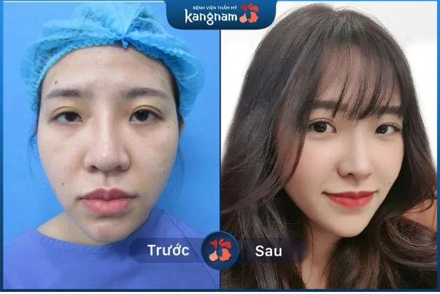Mũi sau khi phẫu thuật trở nên hài hòa hơn với gương mặt