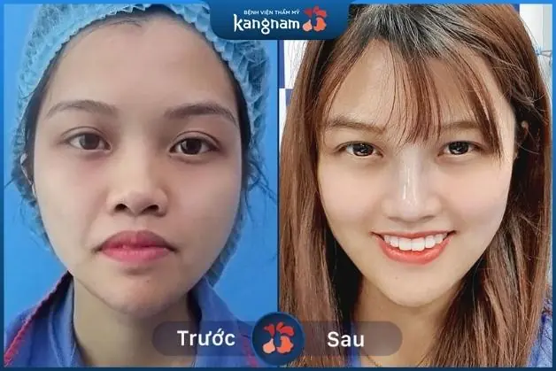 Khách hàng Mỹ Lệ chia sẻ sau khi nâng mũi