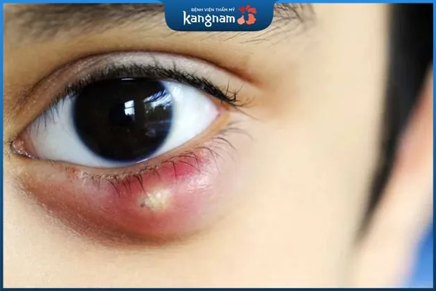 Nguyên nhân gây nên mụn lẹo ở mắt
