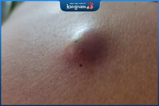 Nguyên nhân hình thành u bã đậu