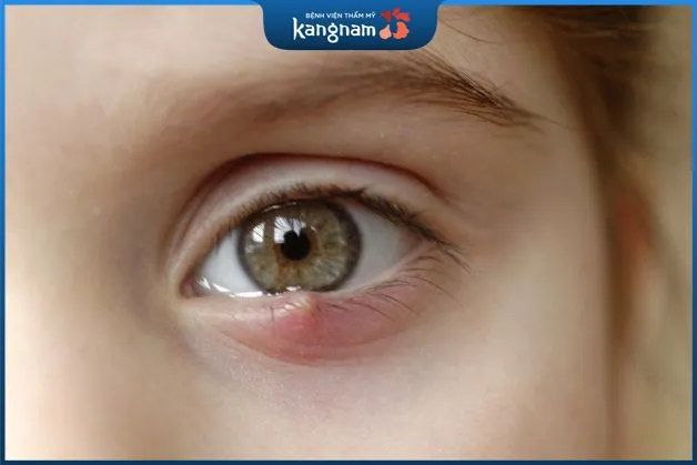 Tìm hiểu về mụn lẹo ở mắt