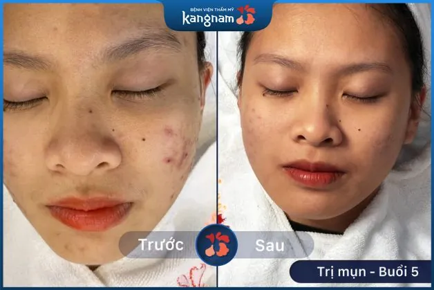 Loại bỏ tận gốc chân mụn, ngăn ngừa nguy cơ tái phát