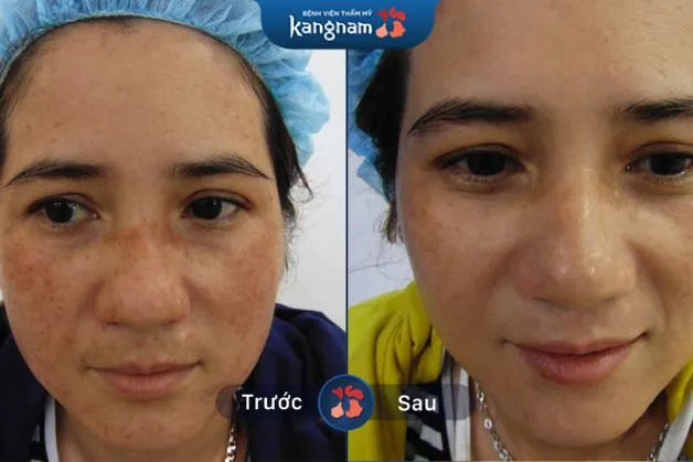 Tại sao bị nám da mặt