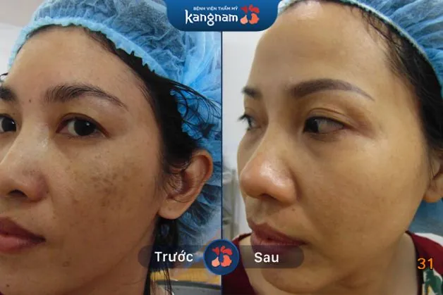 Xóa sạch đến 95% nám lâu năm