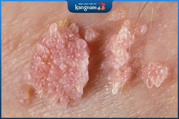 Triệu chứng mụn rộp sinh dục nữ