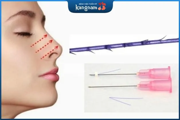 Ưu điểm khi nâng mũi bằng chỉ