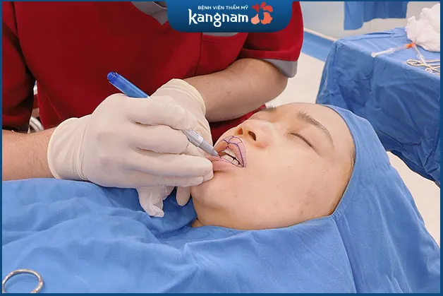 Bác sĩ đo vẽ môi trước phẫu thuật Thu mỏng môi 6D
