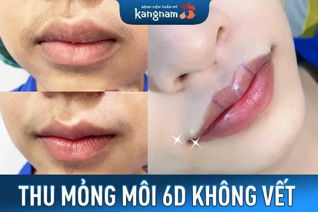 Thu mỏng môi 6D - Công nghệ tạo hình môi không dấu vết độc quyền tại Kangnam