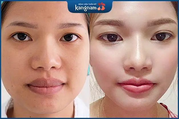 Chị Nguyễn Thị Hồng - Hà Nội sau Thu mỏng môi 6D