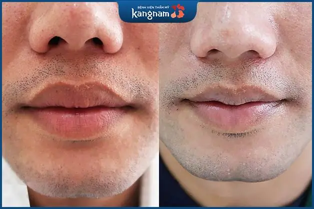 Khách hàng Đặng Quang Anh sử dụng dịch vụ Thu mỏng môi 6D kết hợp Tạo môi tim 6D