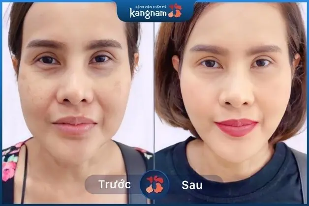 Căng da Mi Young đẹp tự nhiên