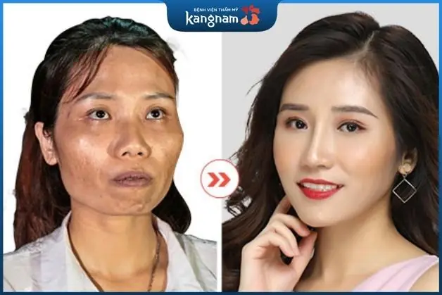 Màn "lột xác" ngoạn mục của cô gái sau khi gọt hàm tại Kangnam