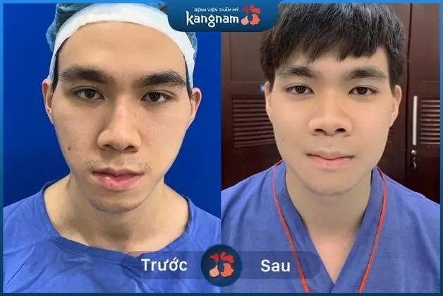 Khách hàng nam hạ gò má giúp gương mặt cân đối hơn