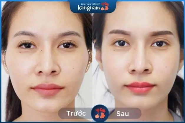 Hạ gò má giúp cho gương mặt trở nên hiền và dịu dàng hơn