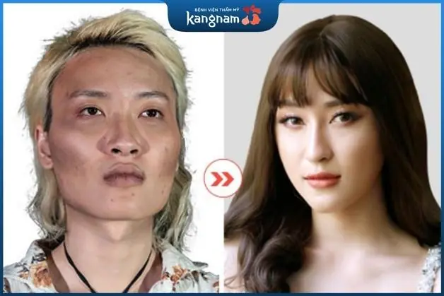 Gương mặt sau khi hạ gò má trở nên mềm mại hơn