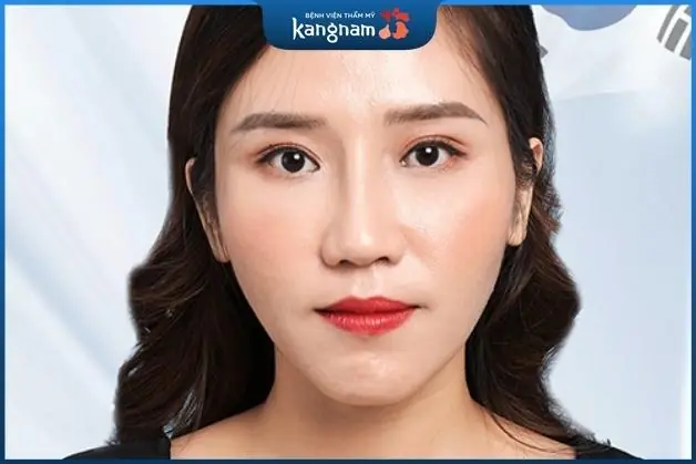 Phẫu thuật hạ gò má mang đến kết quả vĩnh viễn