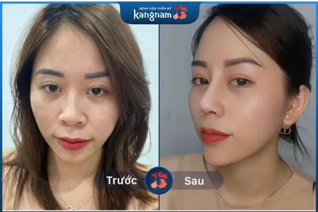 Nâng mũi 6D kết hợp cắt cánh mũi