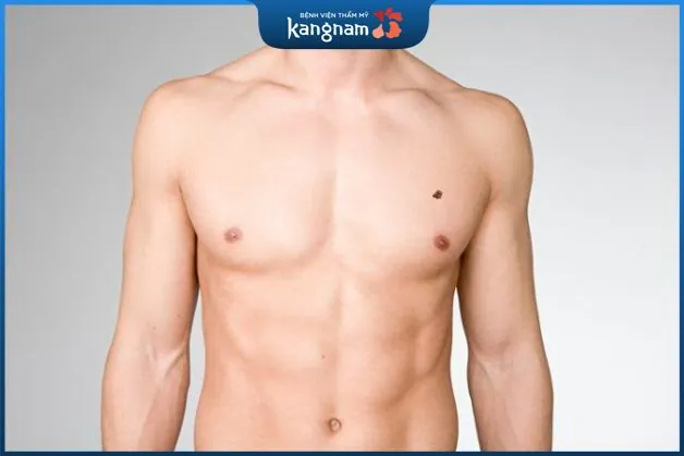 Nốt ruồi trên ngực trái