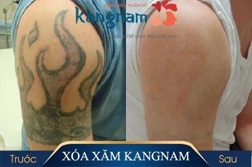 Hình ảnh sau khi xóa xăm