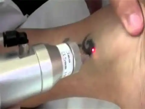 Cách xóa hình xăm trên người