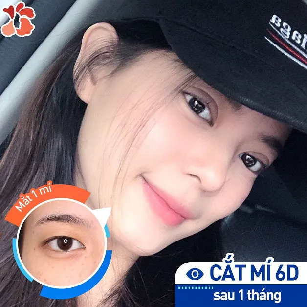 Mí mắt sau 1 tháng đẹp tự nhiên