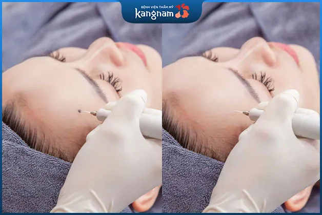 Tẩy nốt ruồi trên trán an toàn tại bệnh viện Kangnam
