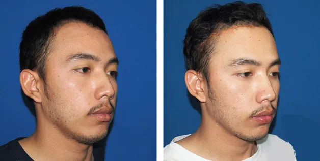 Nam giới gọt trán cho gương mặt hài hòa hơn