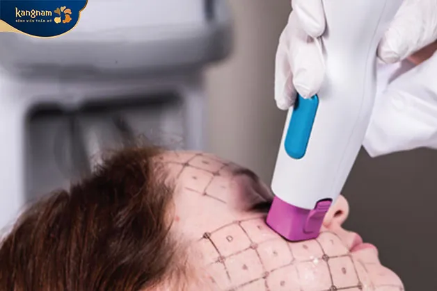 Thermage với cơ chế hiện đại giúp trẻ hóa, nâng cơ nhiều vùng trên khuôn mặt