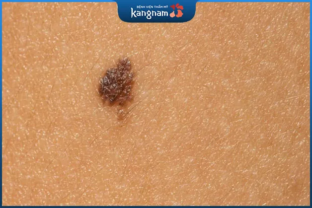 Nốt ruồi màu đen là loại nốt ruồi thường gặp trên cơ thể