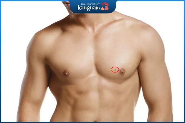 Nốt ruồi ở ngực đàn ông gần nhũ hoa