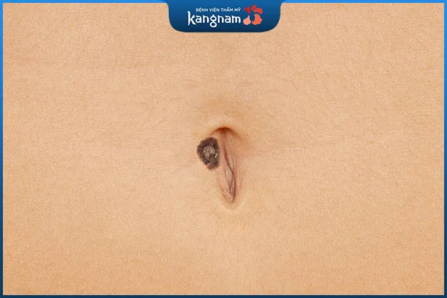 Nốt ruồi phú quý ở rốn