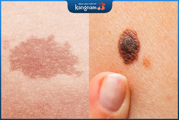 Phân biệt nốt ruồi và vết bớt bẩm sinh