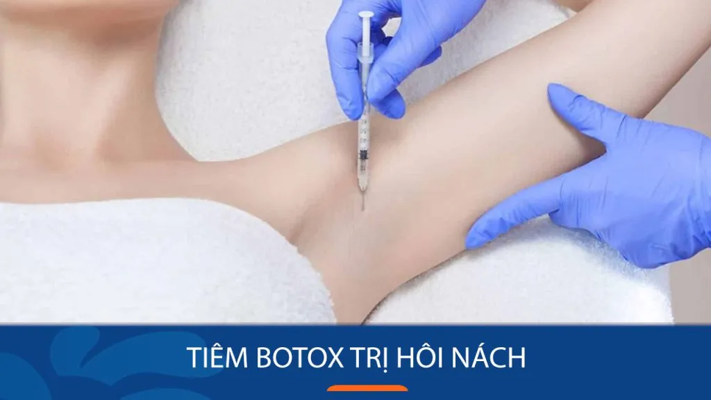 Tiêm Botox trị hôi nách – Loại trừ hơn 90% mùi hôi khó chịu