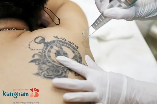 Cách xóa xăm bằng laser thẩm mỹ